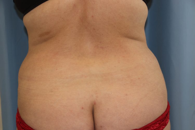 Liposuction Before and After | Dr. Leslie Stevens