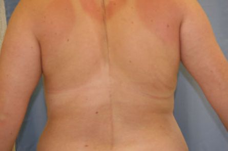 Liposuction Before and After | Dr. Leslie Stevens