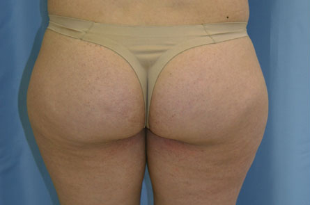 Liposuction Before and After | Dr. Leslie Stevens