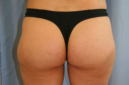 Liposuction Before and After 21