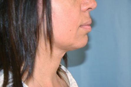 Liposuction Before and After | Dr. Leslie Stevens