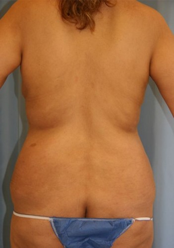 Liposuction Before and After | Dr. Leslie Stevens