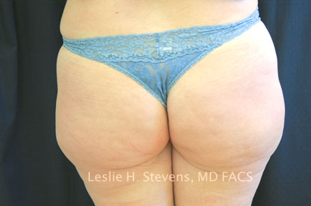 Liposuction Before and After | Dr. Leslie Stevens