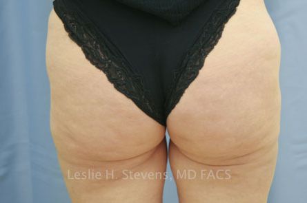 Liposuction Before and After 10