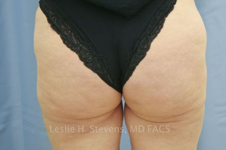 Liposuction Before and After | Dr. Leslie Stevens