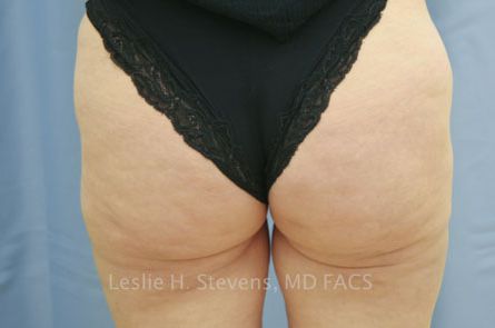 Liposuction Before and After 16