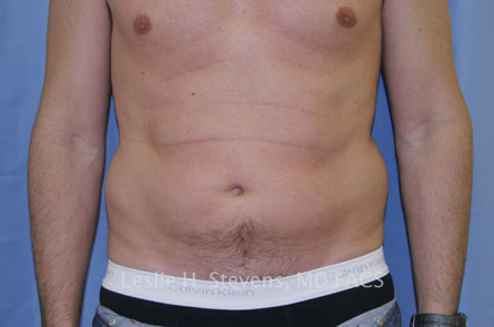 Liposuction Before and After 20