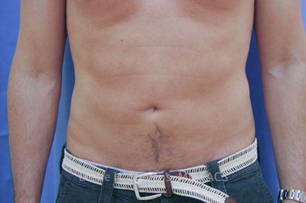 Liposuction Before and After 20