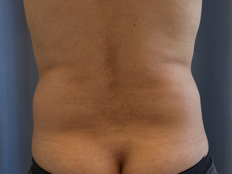 Liposuction Before and After | Dr. Leslie Stevens