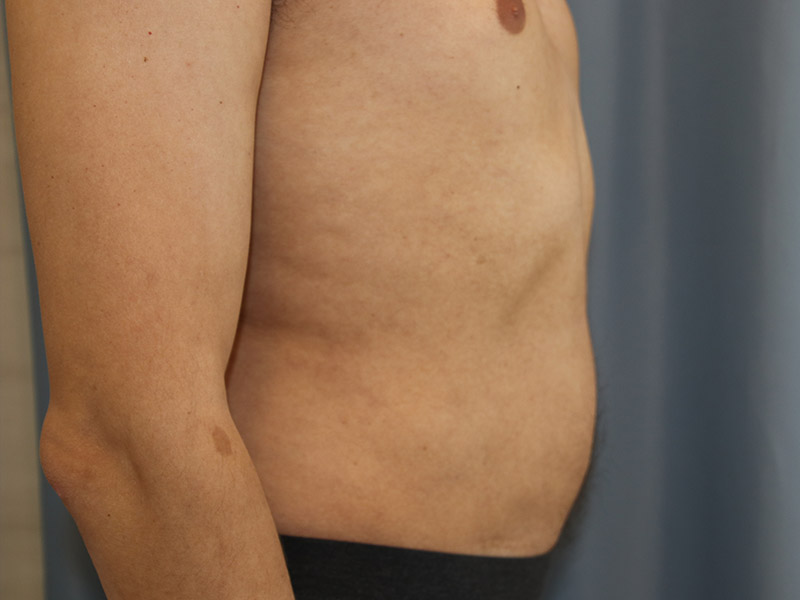 Liposuction Before and After 22