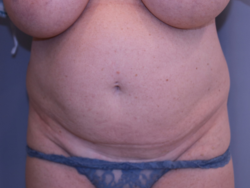 Tummy Tuck Before and After 01