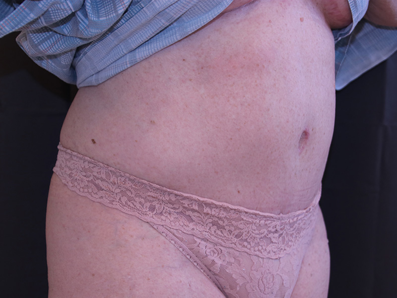 Tummy Tuck Before and After 01