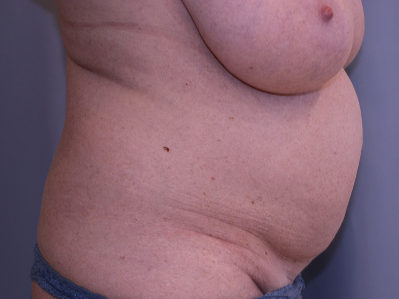 Tummy Tuck Before and After 01