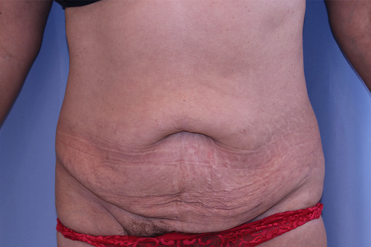 Tummy Tuck Before and After 02