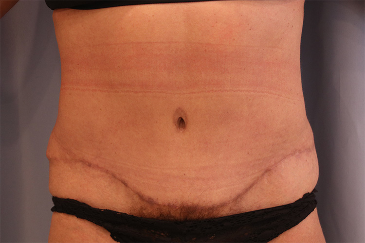 Tummy Tuck Before and After 07