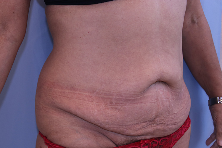 Tummy Tuck Before and After 02