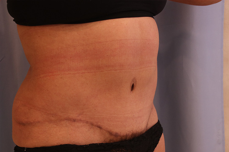 Tummy Tuck Before and After 02