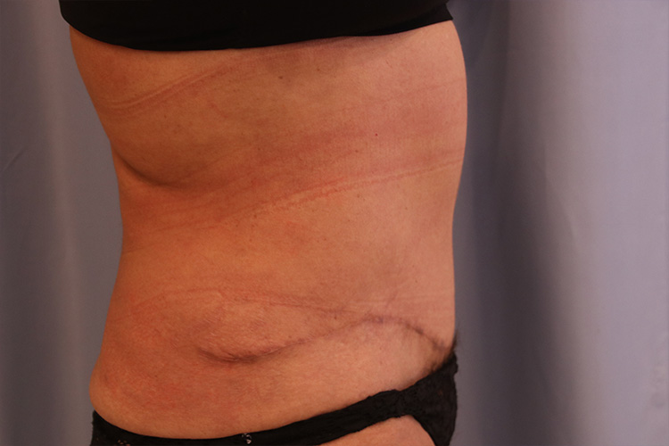 Tummy Tuck Before and After 02