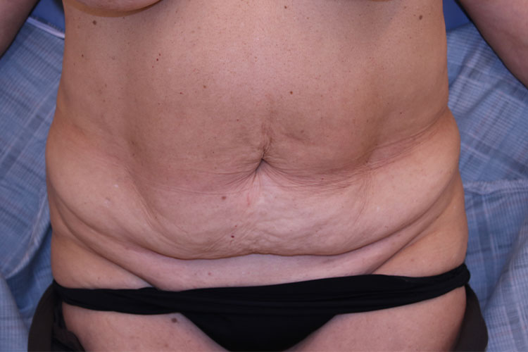 Tummy Tuck Before and After 03