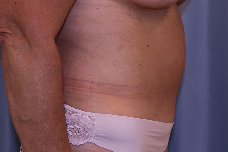 Tummy Tuck Before and After 03