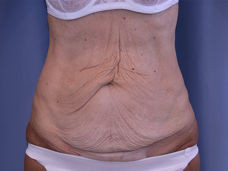 Tummy Tuck Before and After 04