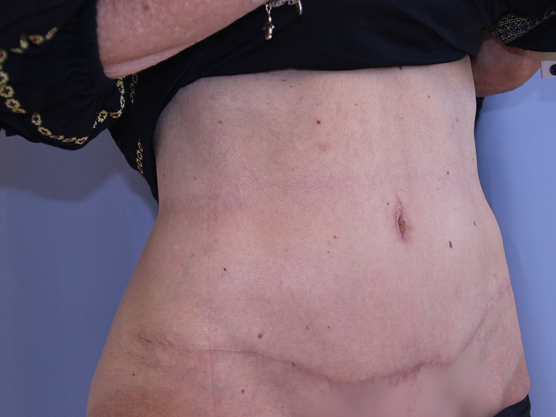 Tummy Tuck Before and After 04