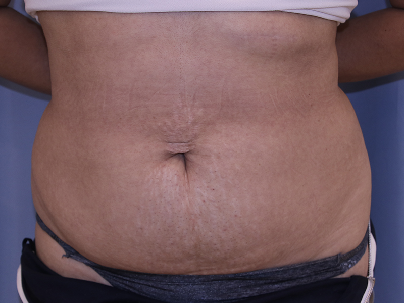 Tummy Tuck Before and After 05