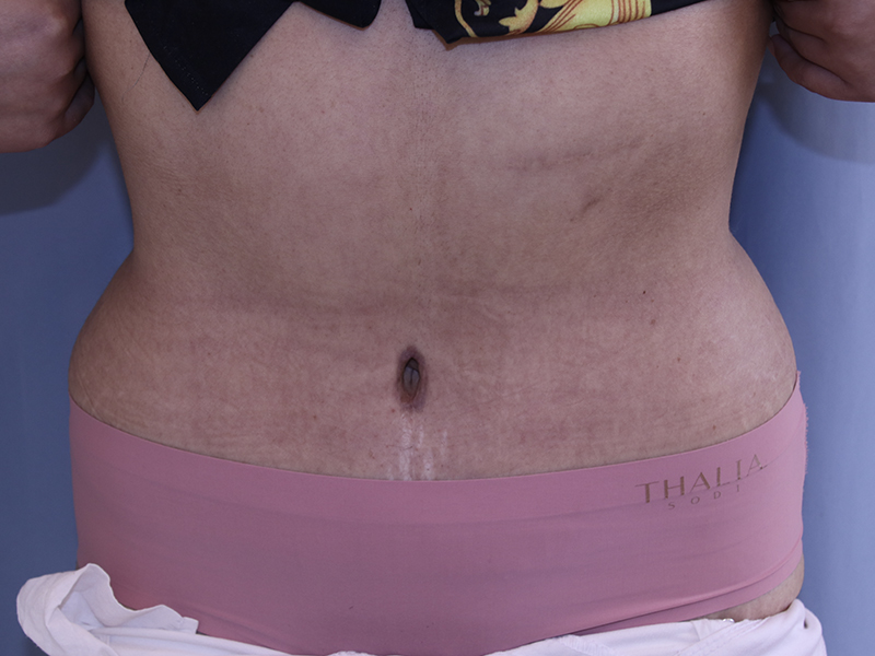 Tummy Tuck Before and After | Dr. Leslie Stevens