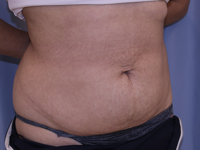 Tummy Tuck Before and After 05