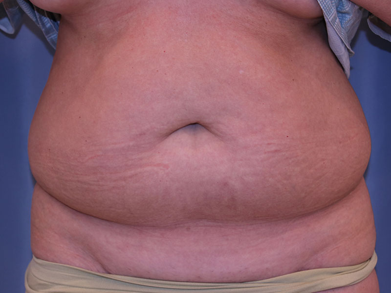 Tummy Tuck Before and After 06