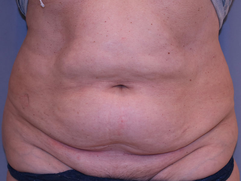 Tummy Tuck Before and After | Dr. Leslie Stevens