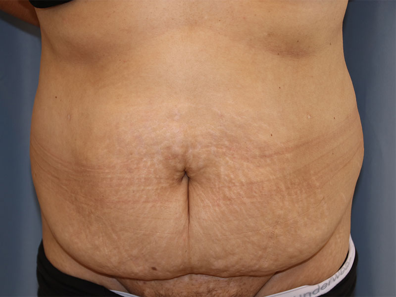 Tummy Tuck Before and After | Dr. Leslie Stevens