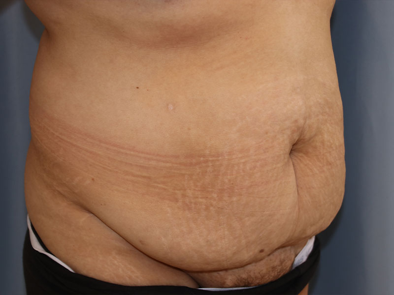 Tummy Tuck Before and After 08