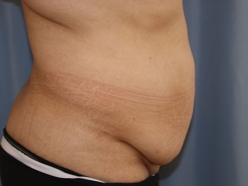 Tummy Tuck Before and After 08