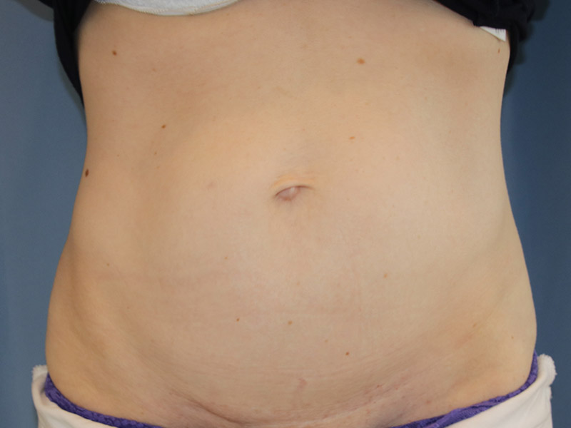 Tummy Tuck Before and After | Dr. Leslie Stevens