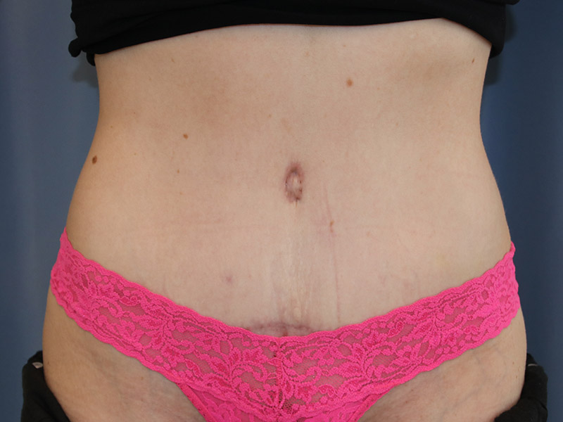 Tummy Tuck Before and After 12