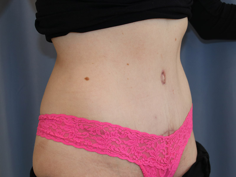 Tummy Tuck Before and After 09