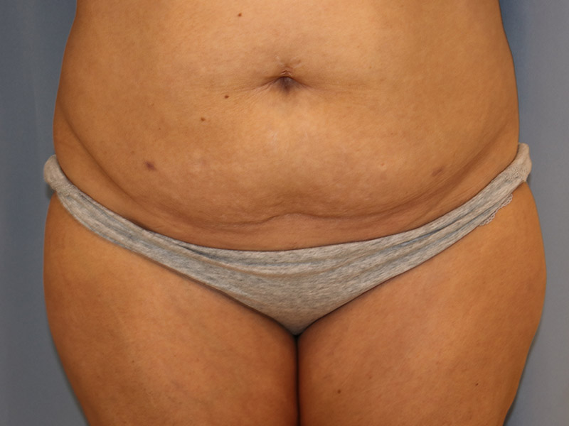 Tummy Tuck Before and After 10