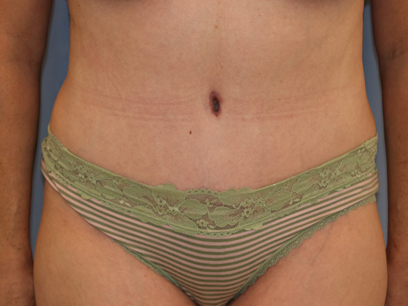 Tummy Tuck Before and After 20