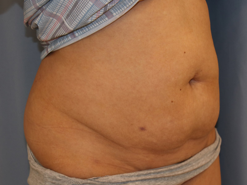 Tummy Tuck Before and After 10