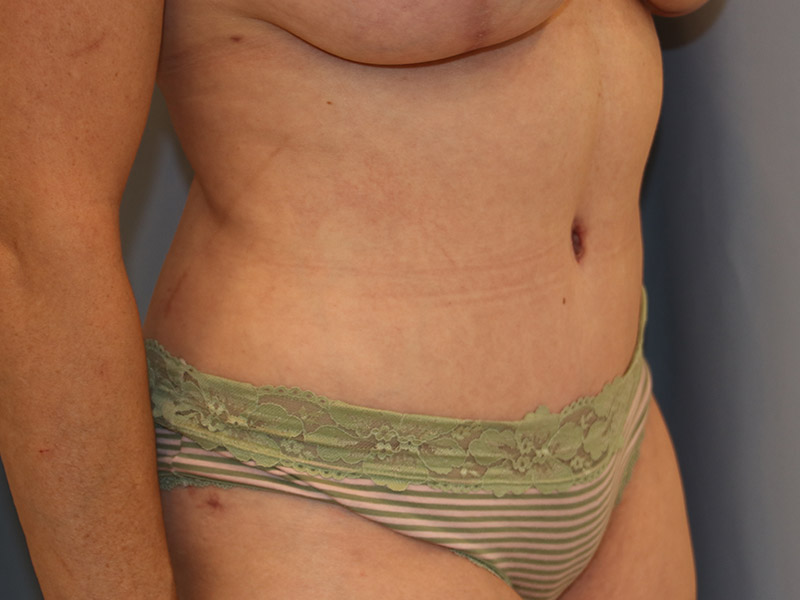 Tummy Tuck Before and After 10