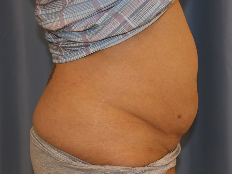 Tummy Tuck Before and After 10