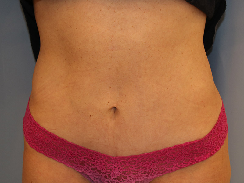 Tummy Tuck Before and After | Dr. Leslie Stevens