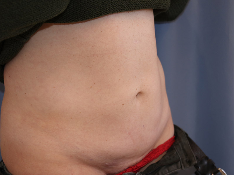 Tummy Tuck Before and After 11