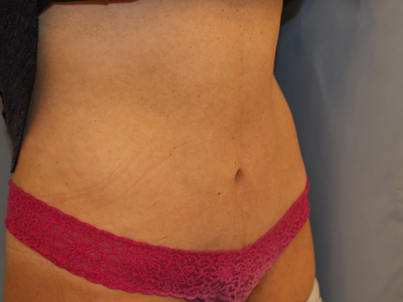 Tummy Tuck Before and After 11