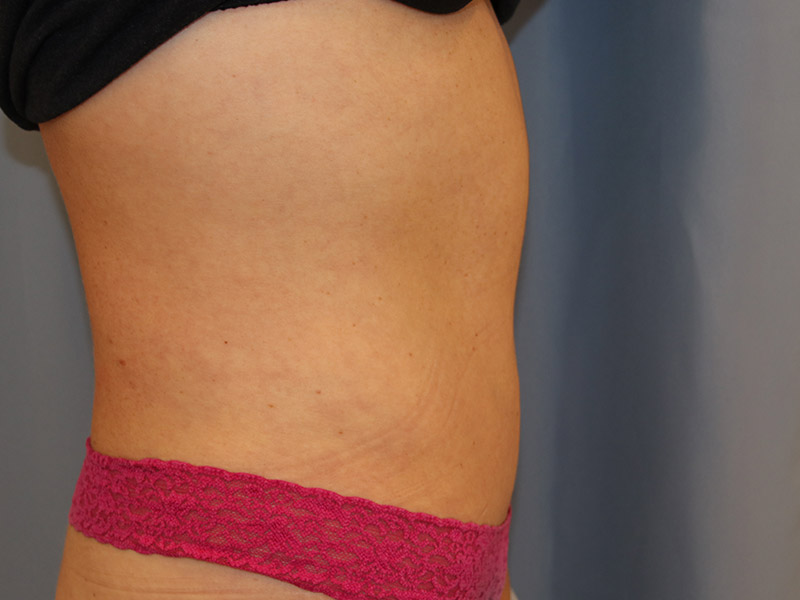 Tummy Tuck Before and After 11