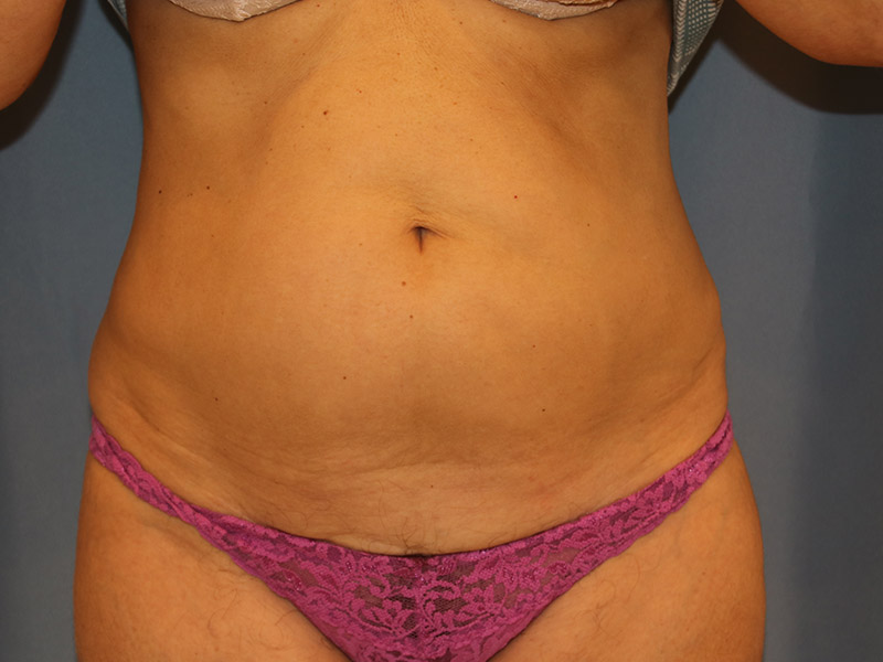 Tummy Tuck Before and After 12