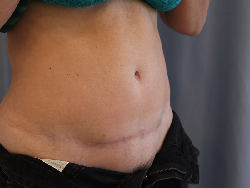 Tummy Tuck Before and After 12