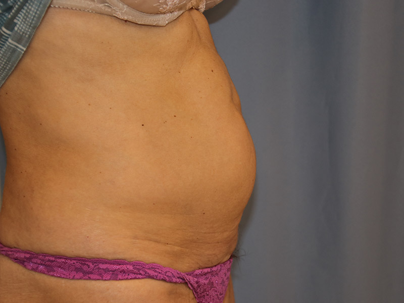 Tummy Tuck Before and After 12