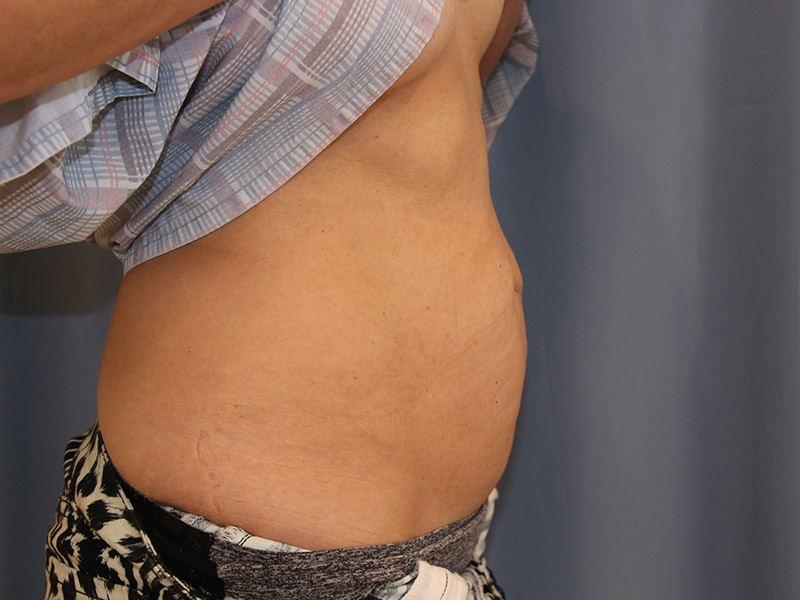 Tummy Tuck Before and After 13